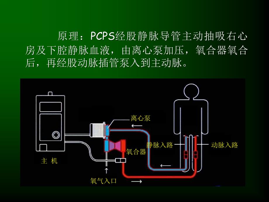 经皮心肺支持系统在急性心肌炎中的应用吴平生_第3页