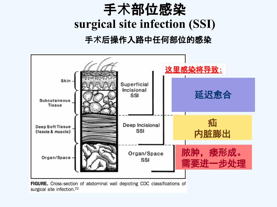 预防性抗菌素与外科部位感染控制课件_第2页