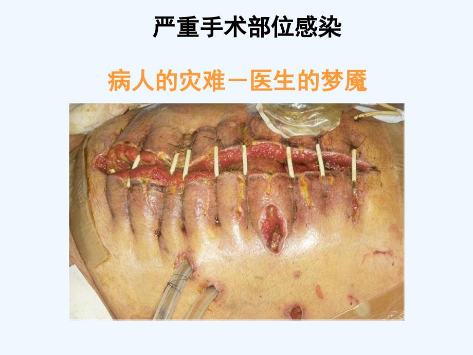 预防性抗菌素与外科部位感染控制课件_第4页