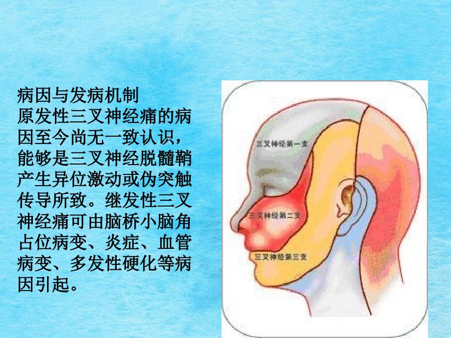 叉神经痛患者的护理定ppt课件_第4页