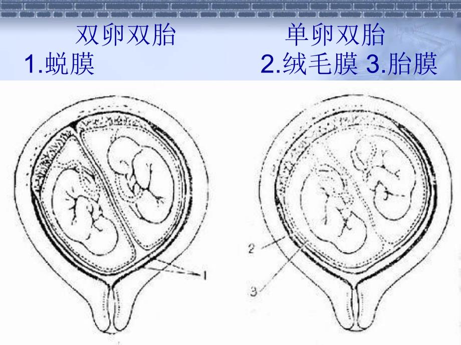 多胎妊娠和产科处理_第4页