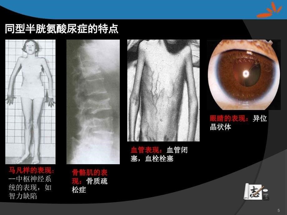 同型半胱氨酸的检测及临床应用_第5页