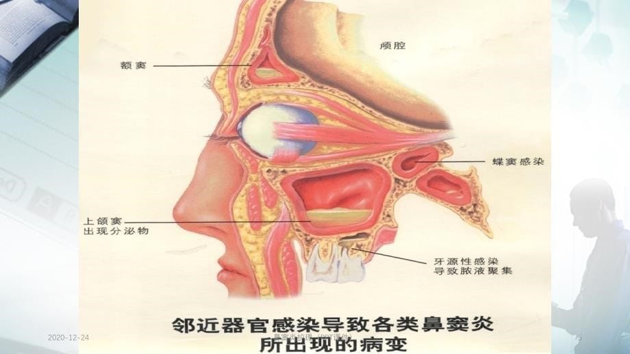 鼻窦炎护理PPT课件_第5页