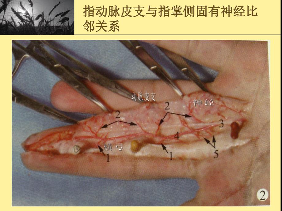 指动脉皮支与指掌侧固有神经比邻关系及其临床意义_第3页