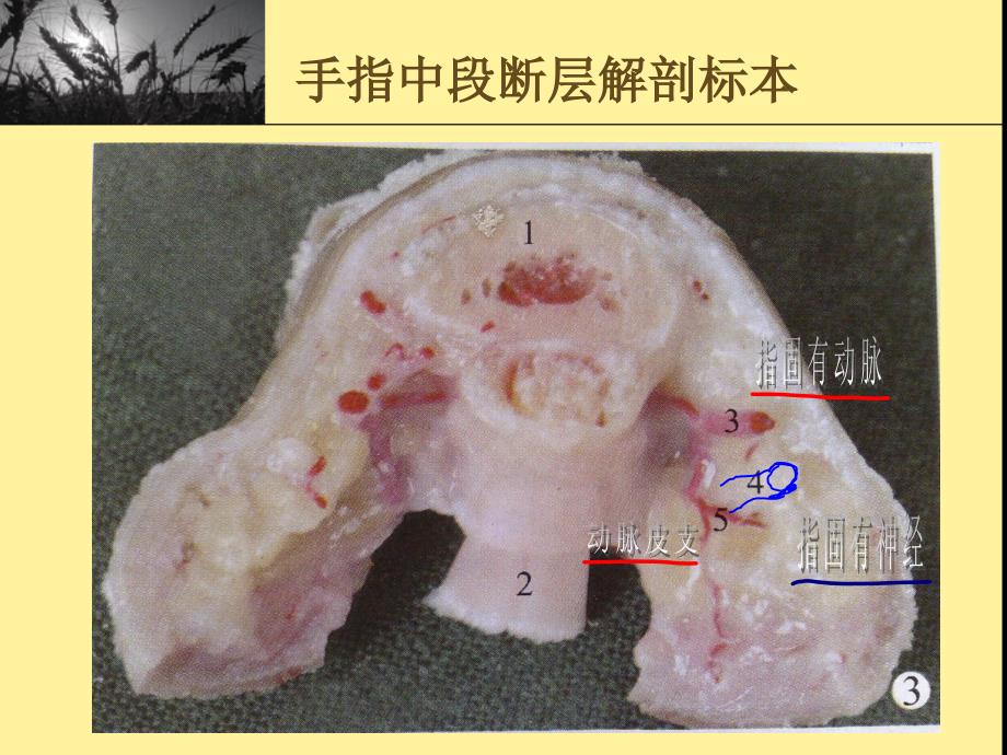 指动脉皮支与指掌侧固有神经比邻关系及其临床意义_第4页