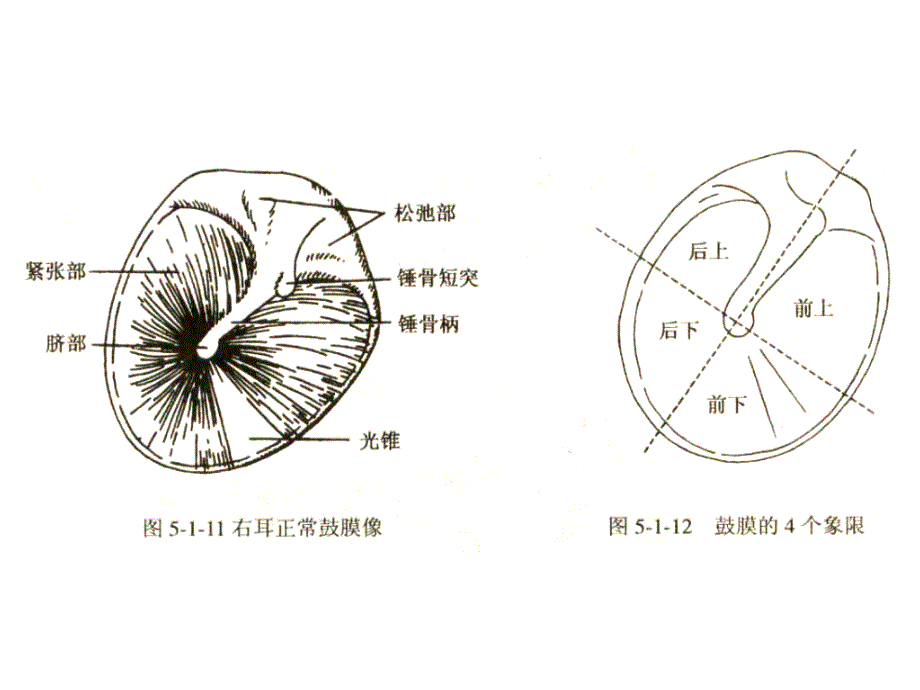 化脓性中耳炎及其并发症_第3页