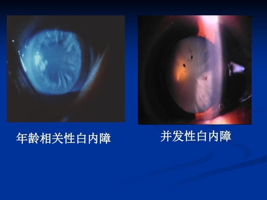 白内障的分类、诊断与治疗原则_第5页