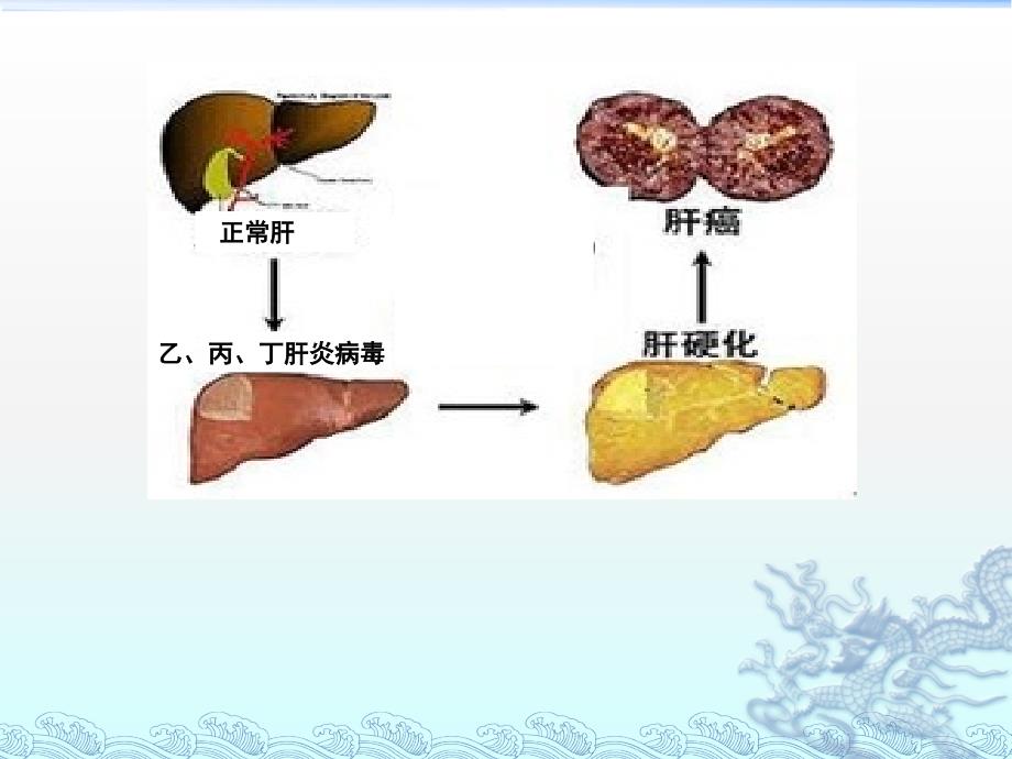 传染病护理学病毒性肝炎课件_第4页