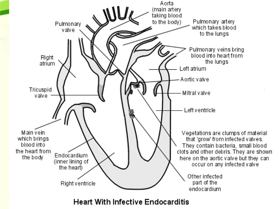 感染性心内膜炎--标准课件025_第4页