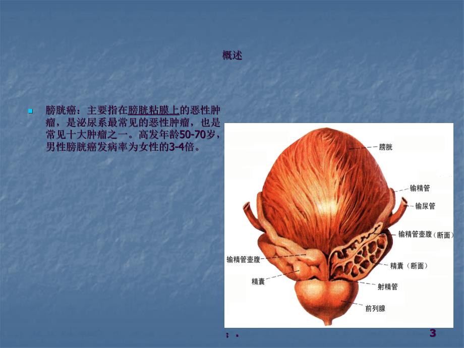 膀胱癌护理查房ppt课件_第3页