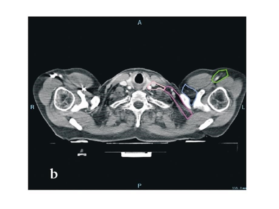 乳癌放射治疗靶区勾画_第5页