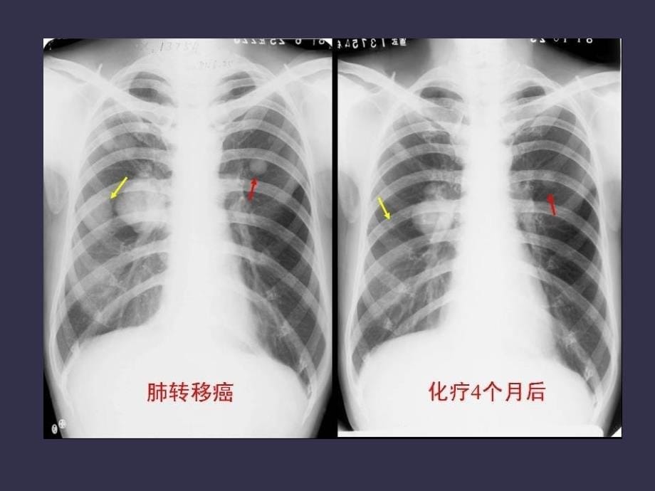 肺癌的影像诊断2_第5页