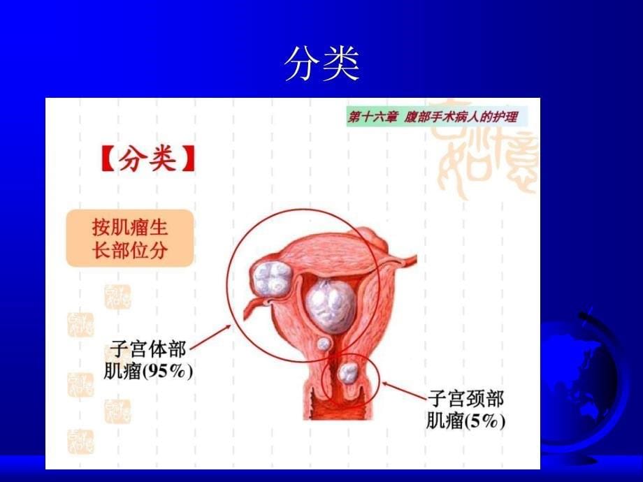 子宫肌瘤个案护理查房ppt课件_第5页