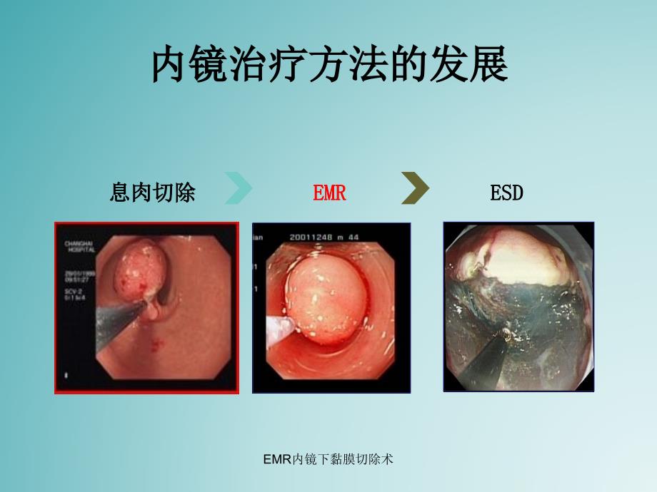 EMR内镜下黏膜切除术_第3页