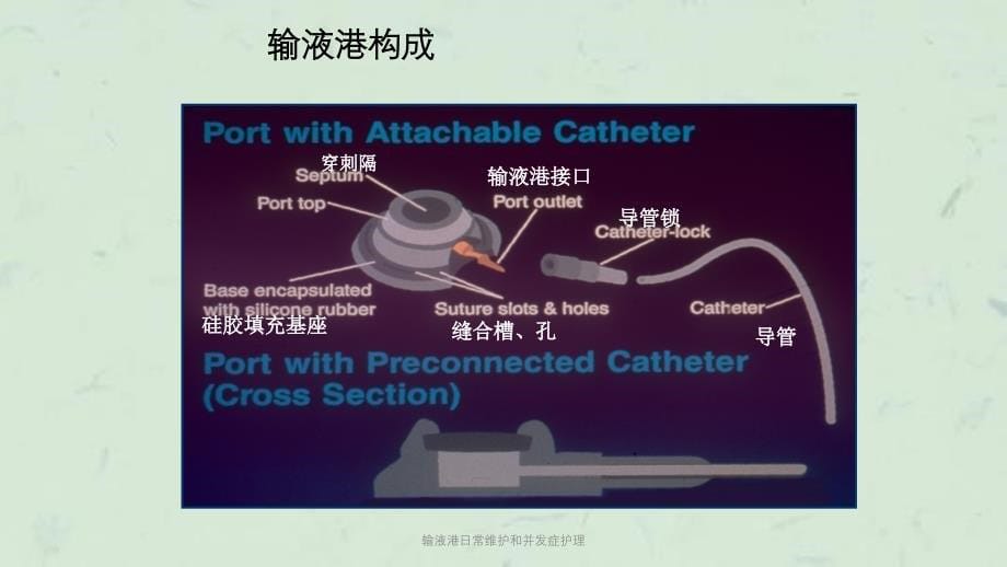 输液港日常维护和并发症护理课件_第5页