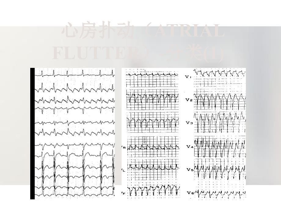 房扑房颤的治疗_第5页
