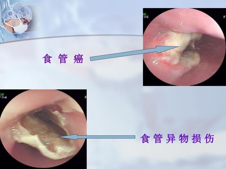 最新(内科护理学)第十二节上消化道大出血精选PPT文档_第5页