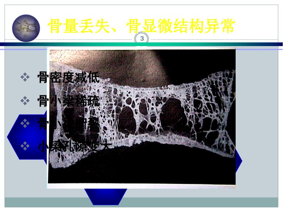 骨水泥治疗压缩骨折ppt课件_第3页