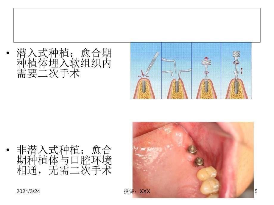 种植手术外科操作规范PPT课件_第5页