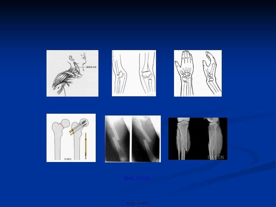 四肢骨折的手术配合演示文稿学习教案_第5页