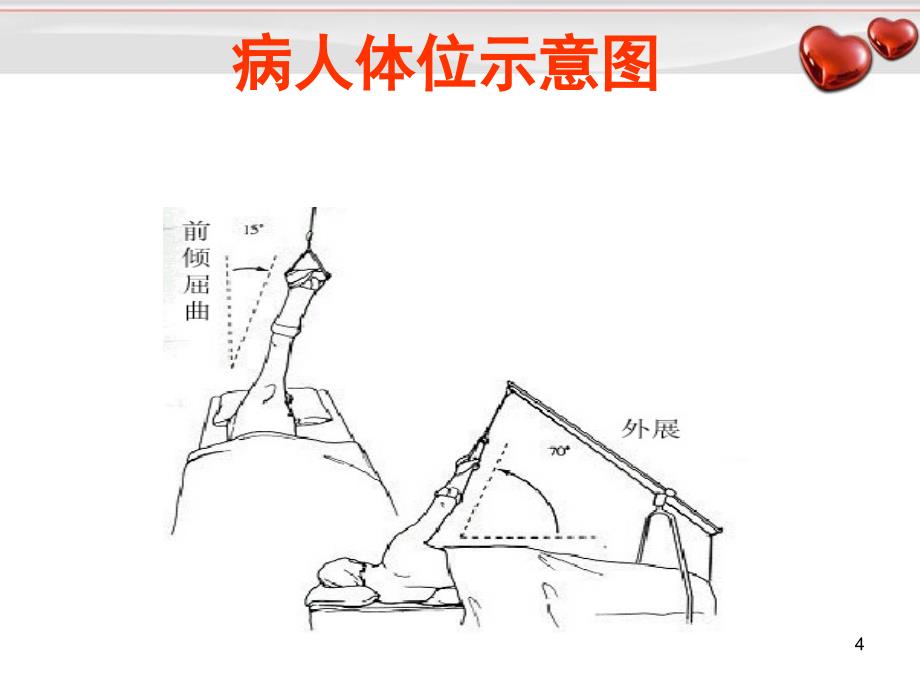 推荐精选肩关节镜简介及肩周炎的鉴别诊断_第4页