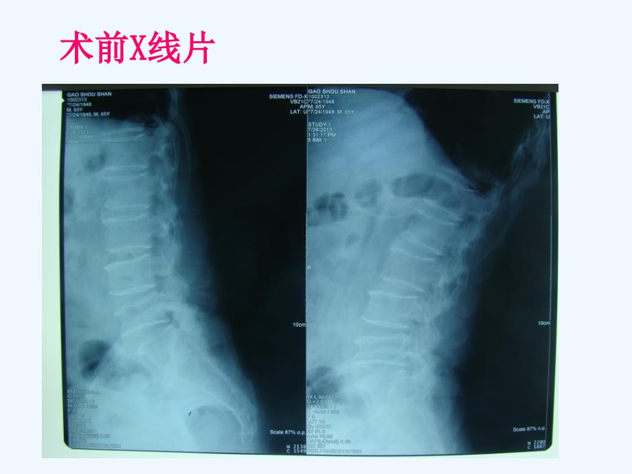 腰椎间盘突出症围手术期护理课件_第4页