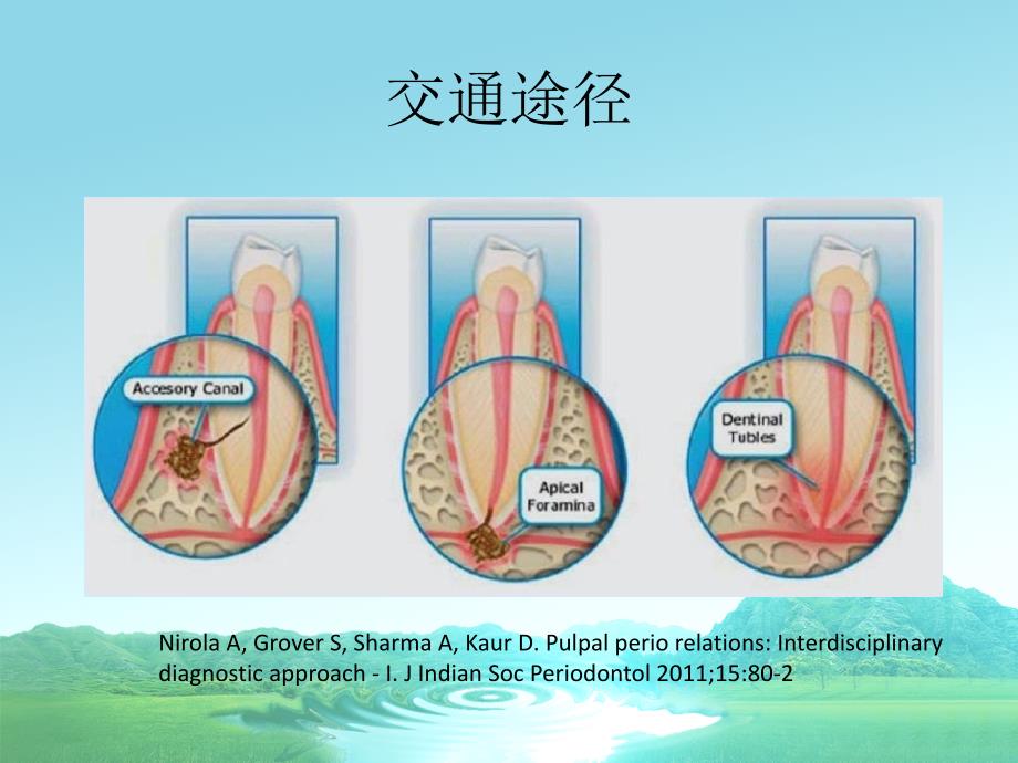 牙周炎的伴发病变课件_第4页