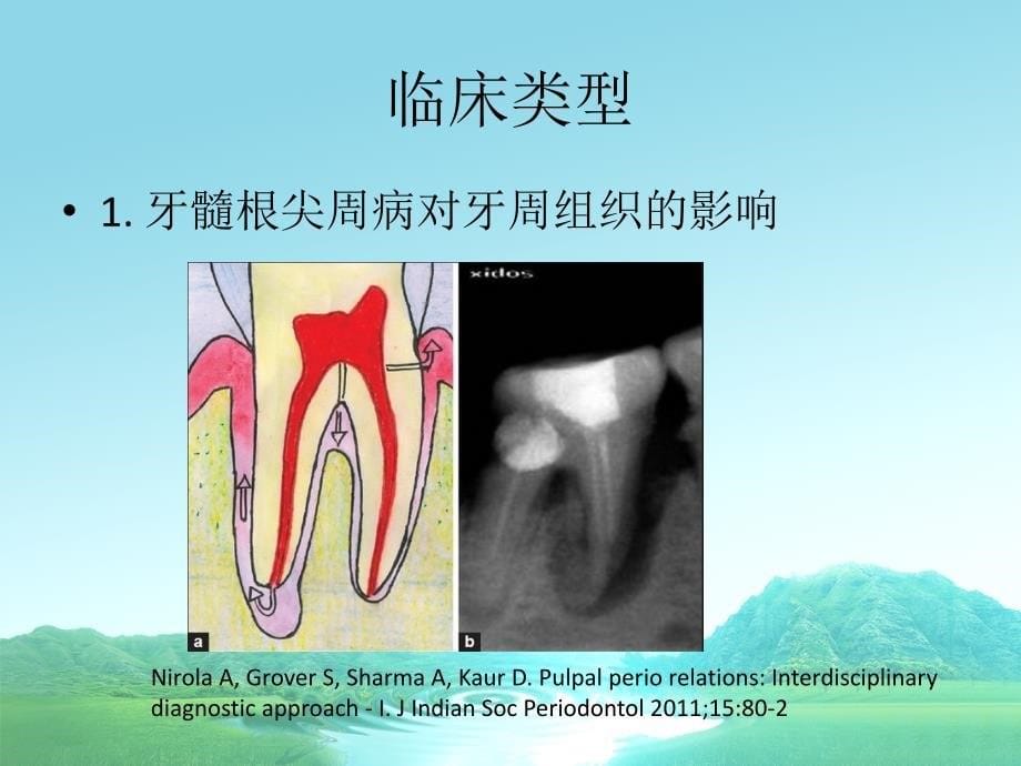 牙周炎的伴发病变课件_第5页