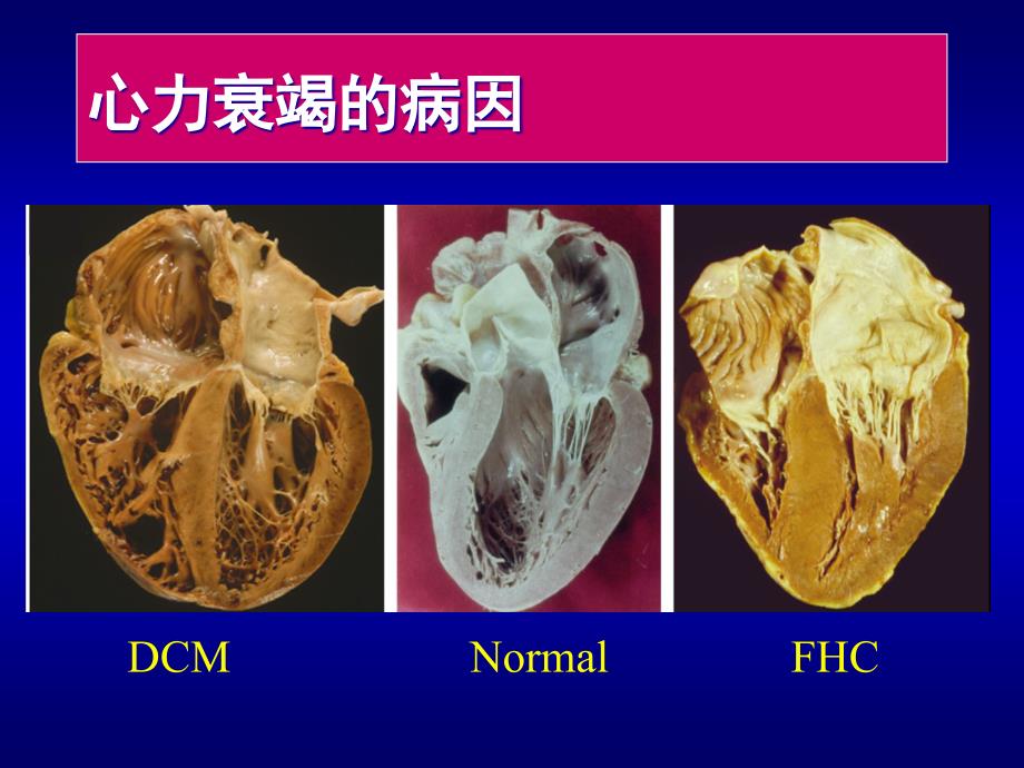 心力衰竭护理_课件.刘志红--ppt_第4页