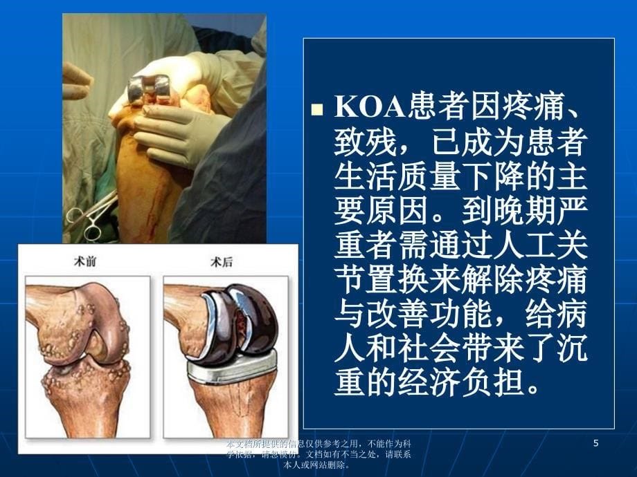 膝关节骨性关节炎的诊断及治疗_第5页