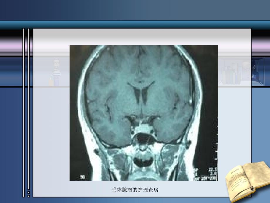 垂体腺瘤的护理查房课件_第4页