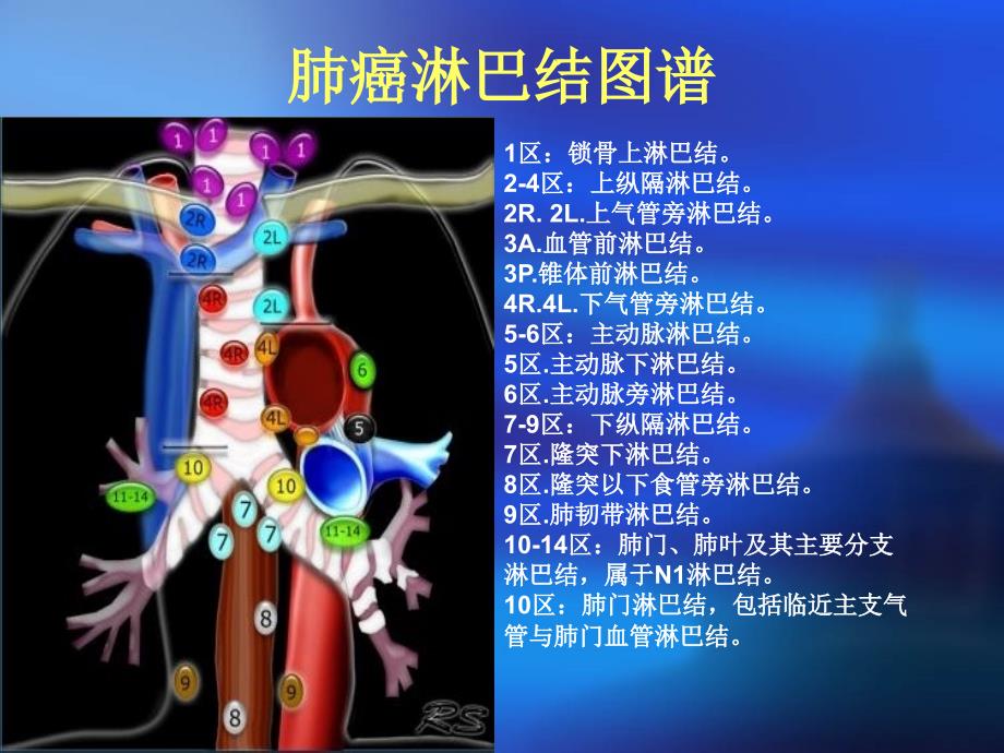 肺癌淋巴结图谱.ppt_第3页