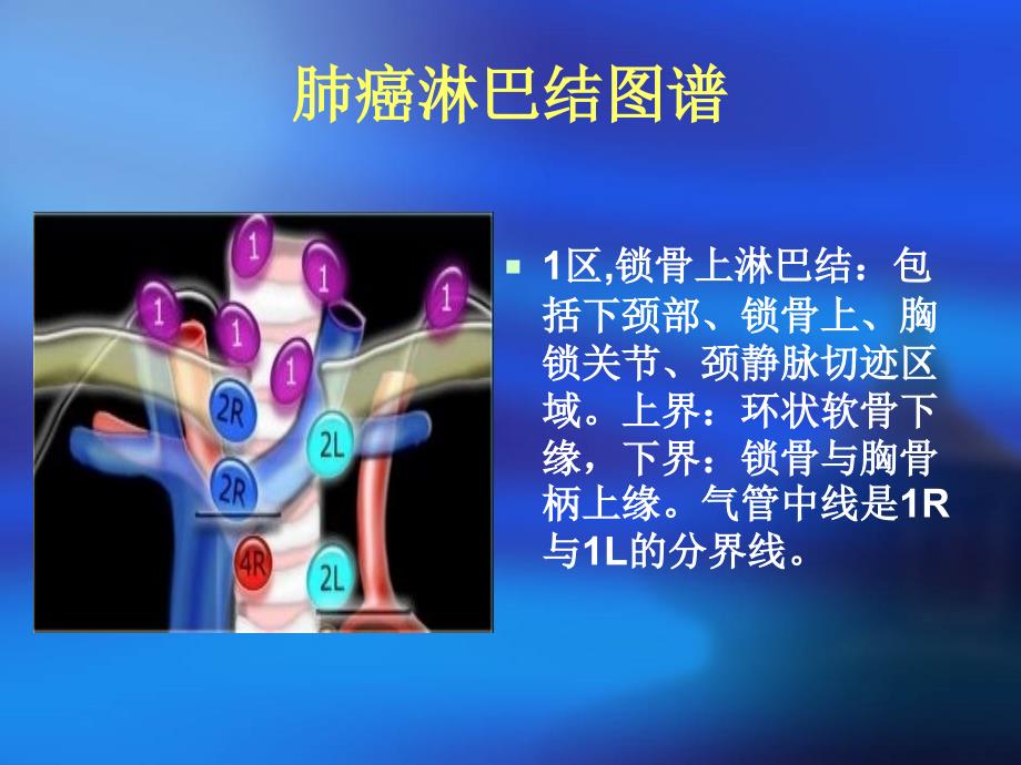 肺癌淋巴结图谱.ppt_第4页