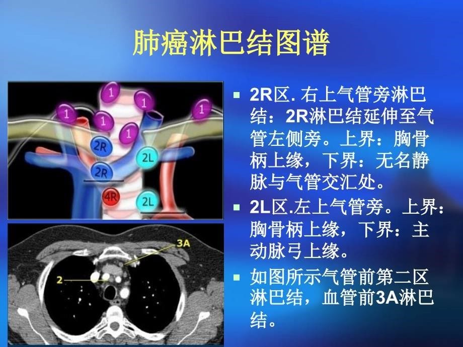 肺癌淋巴结图谱.ppt_第5页