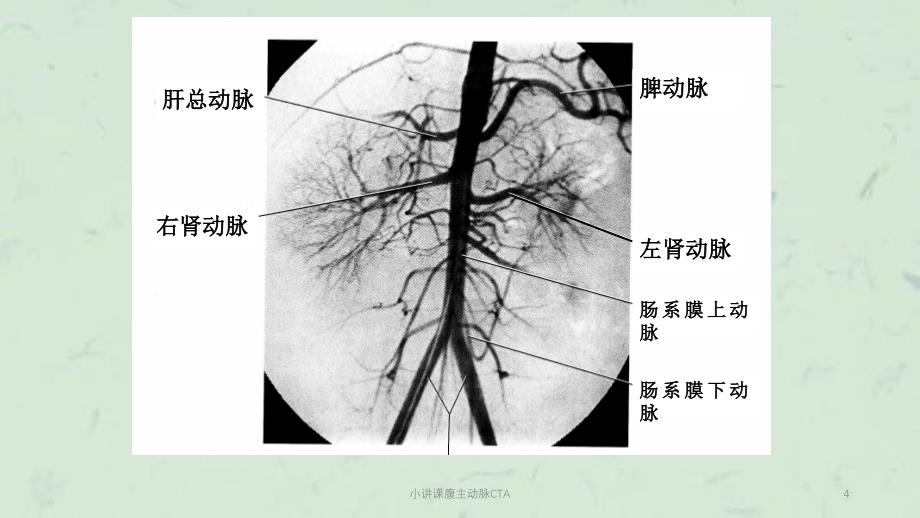 小讲课腹主动脉CTA课件_第4页