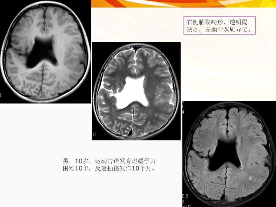 医学影像癫痫的MRI及MRS_第3页