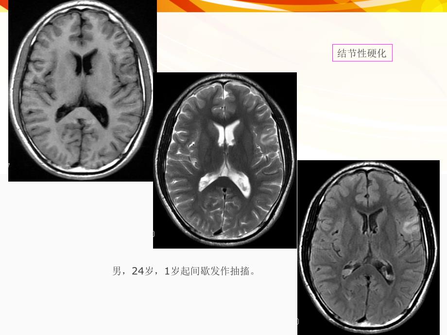 医学影像癫痫的MRI及MRS_第4页