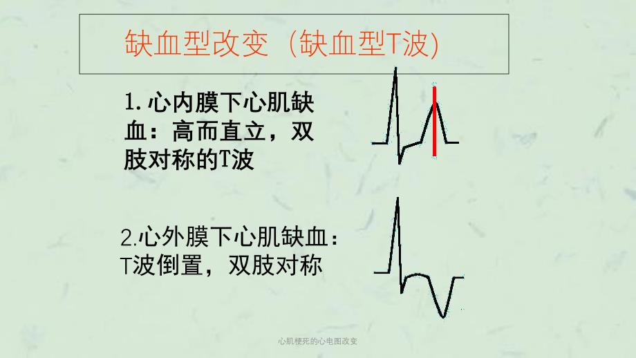 心肌梗死的心电图改变课件_第4页