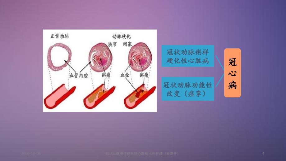 冠状动脉粥样硬化性心脏病人的护理新_第4页