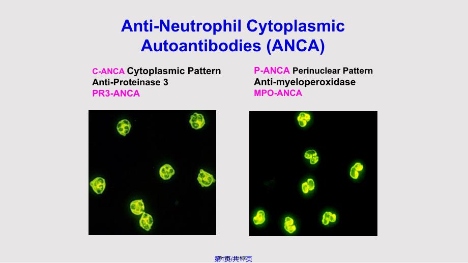 ANCA相关性血管炎肾损害病理表现实用教案_第1页