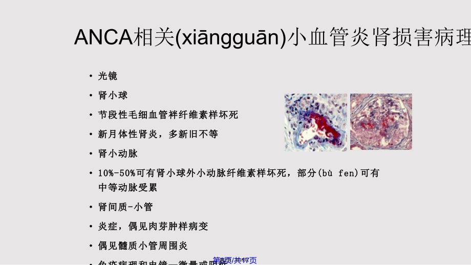 ANCA相关性血管炎肾损害病理表现实用教案_第3页