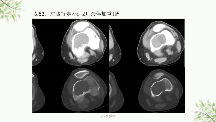 骨巨细胞瘤及纤维组织细胞类肿瘤课件_第3页