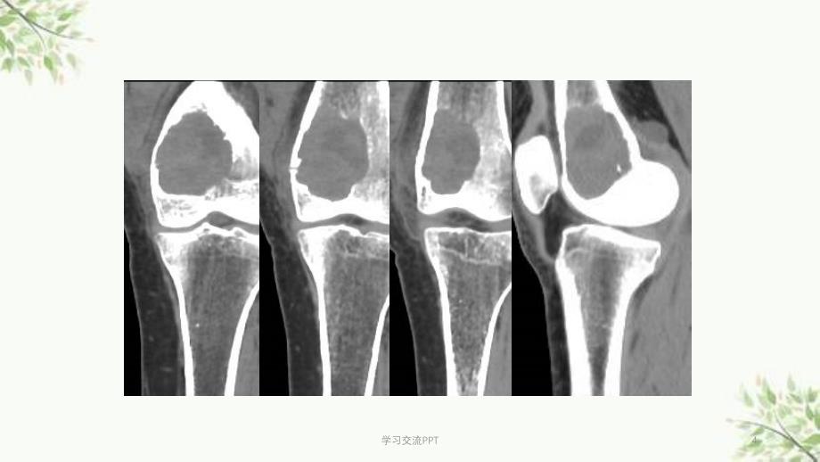 骨巨细胞瘤及纤维组织细胞类肿瘤课件_第4页