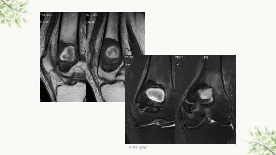 骨巨细胞瘤及纤维组织细胞类肿瘤课件_第5页