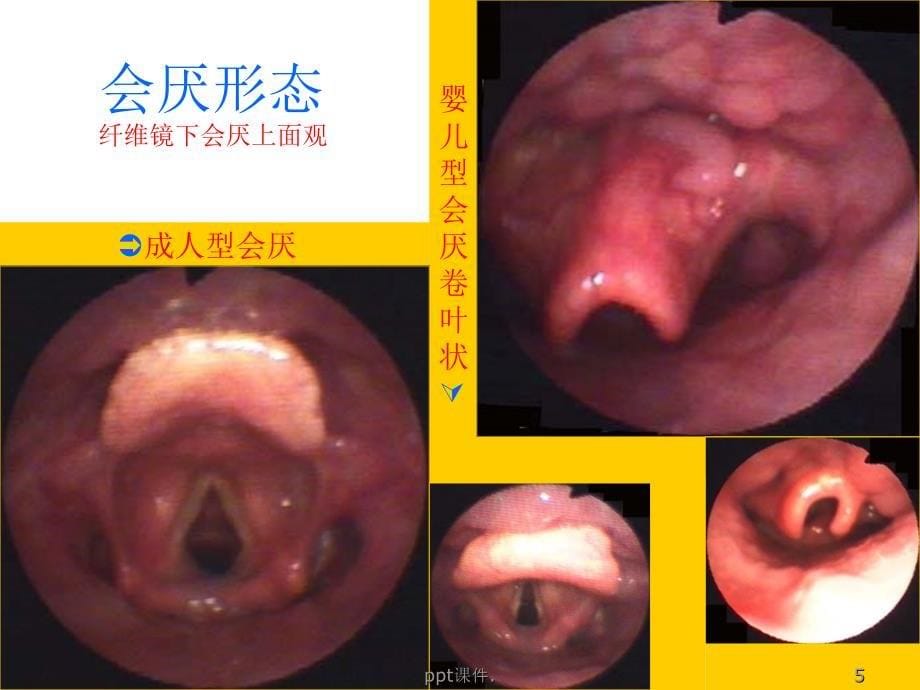 喉解剖喉阻塞精选幻灯片_第5页