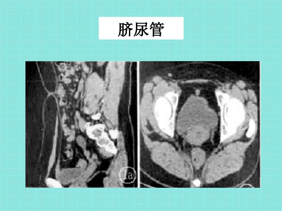 脐尿管.ppt_第4页