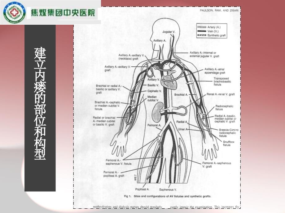 内瘘血管评估使用和维护_第3页