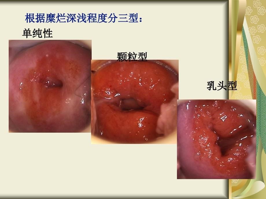 在第十四章第三节慢性宫颈炎_第5页