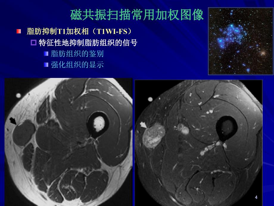 医学课件骨肌磁共振诊断基础_第4页