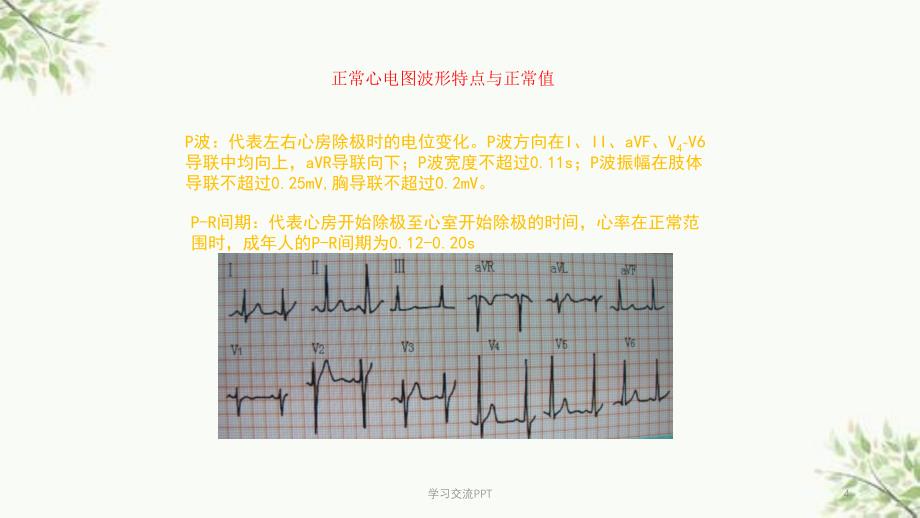 各种心电图表现课件_第4页